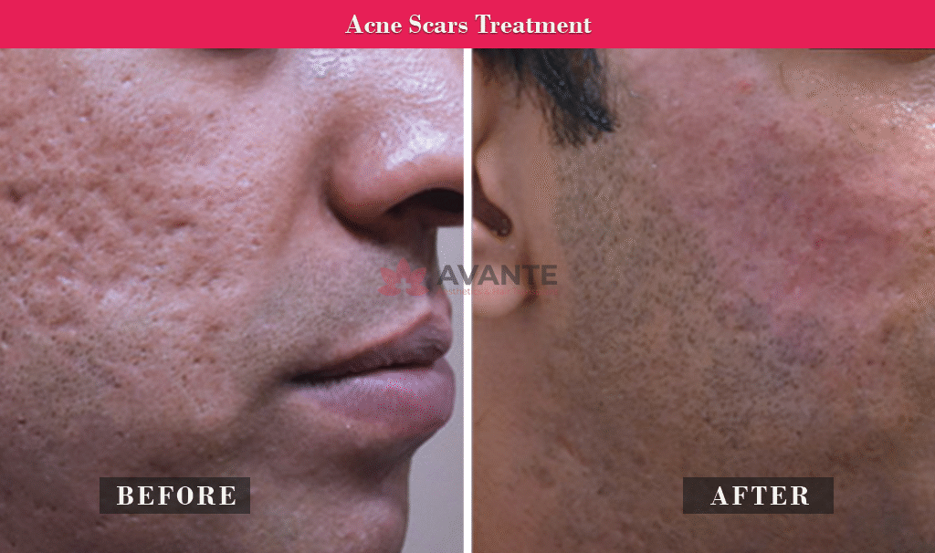 Acne-Scars-treatment