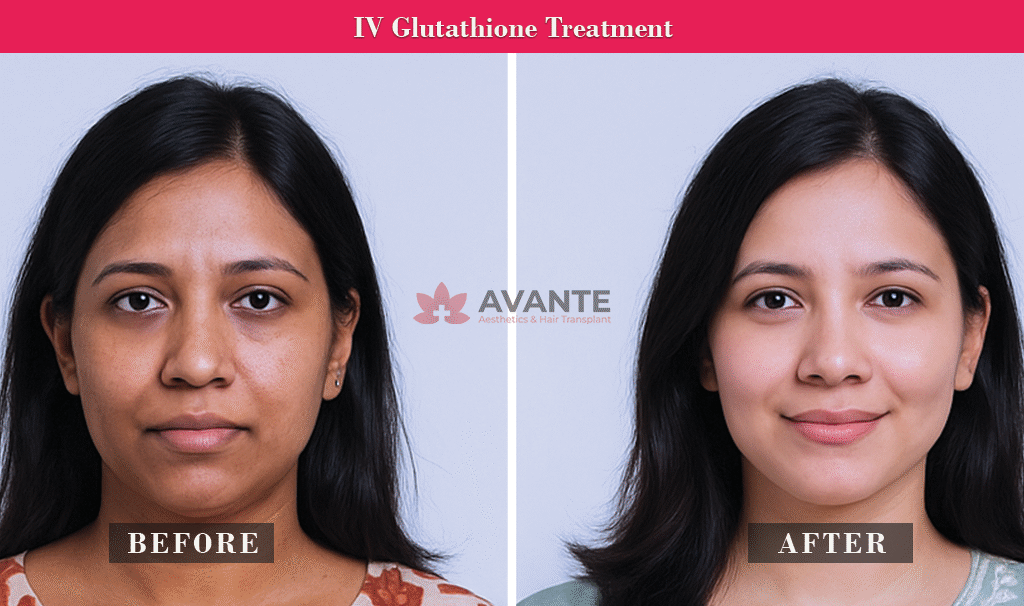 IV-glutathione-treatment