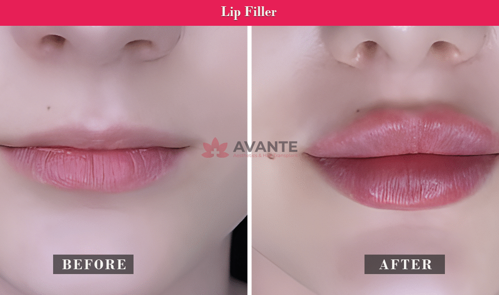 LIp-Filler