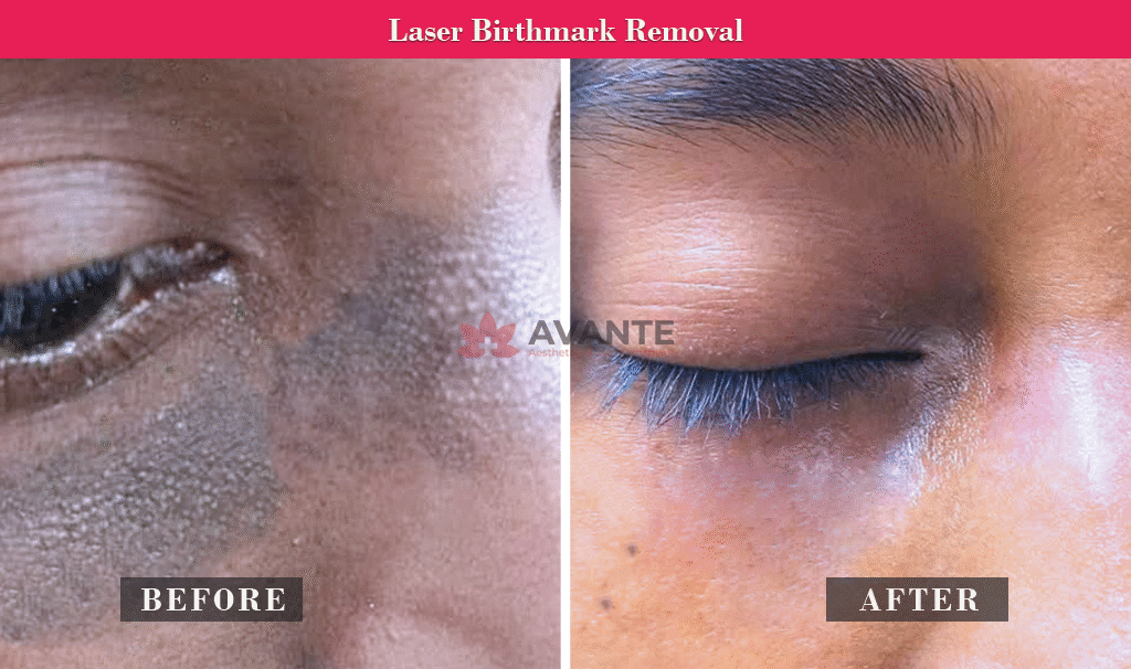 Laser-Birthmark-Removal