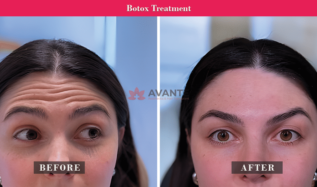 botox-treatment