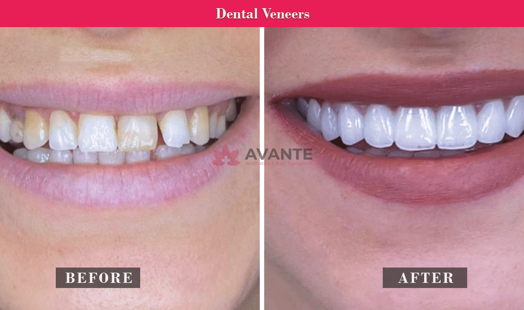 dental-veneers