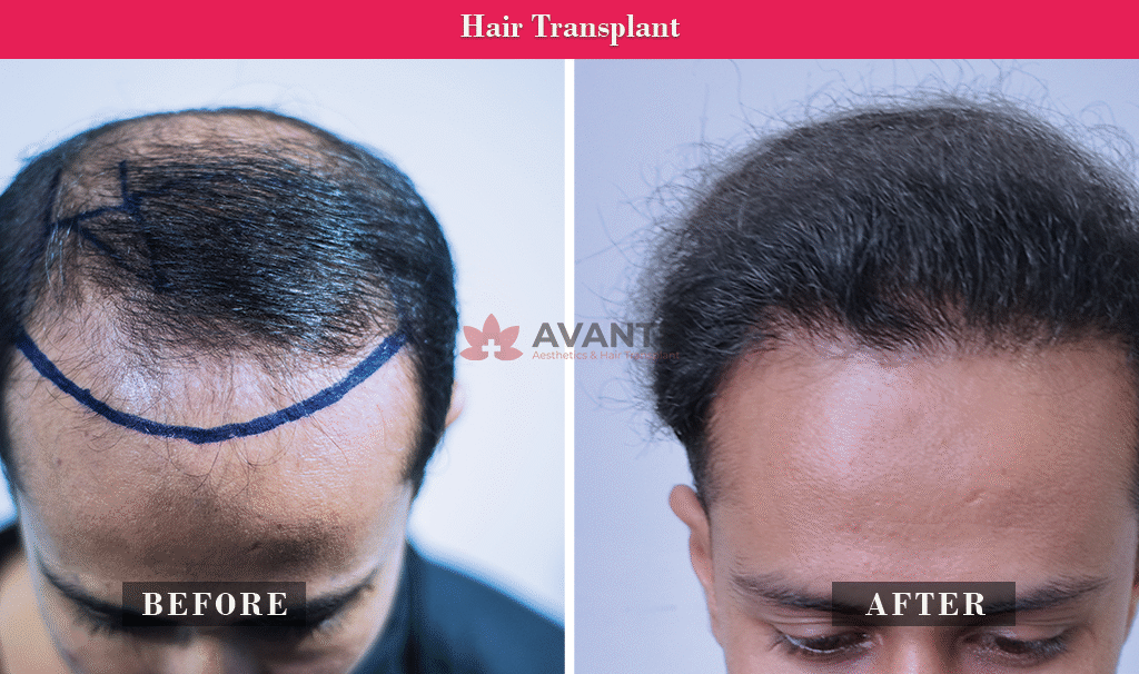 hair-transplanat