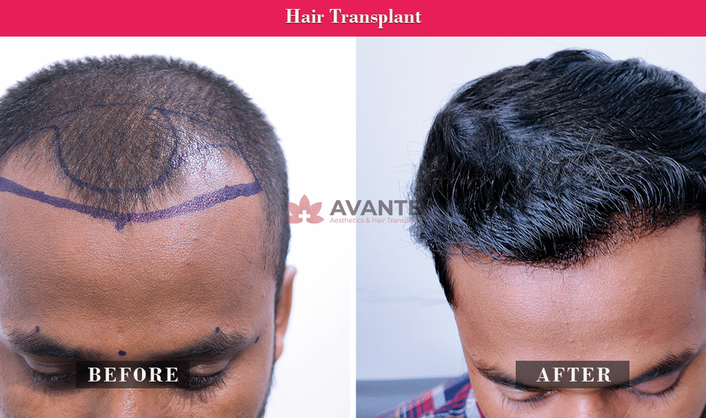 hair-transplant-2