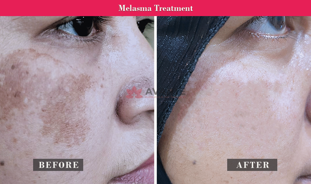 melasma-treatment