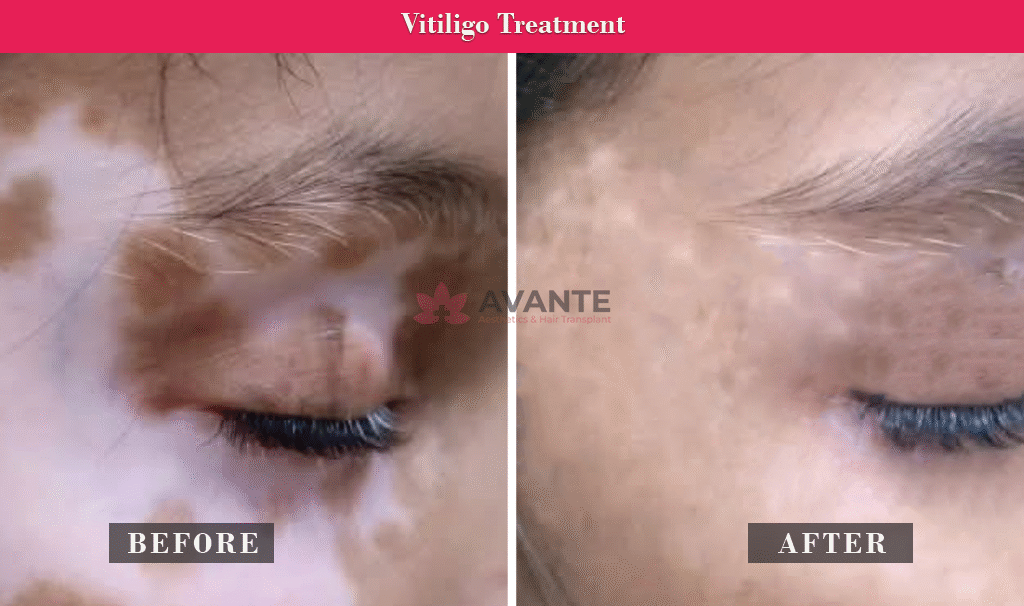 vitiligo-treatment